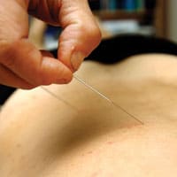 acupuncture sheffield