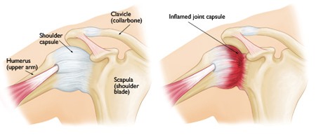 Treating A Frozen Shoulder Through Massage Therapy